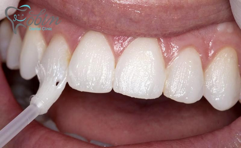  پیشگیری از پوسیدگی دندان با فلوراید تراپی
